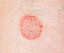 Breast Fungus (Itchy Fungal Rash) Causes, Pictures ...