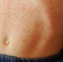 Heat rash Symptoms - Mayo Clinic
