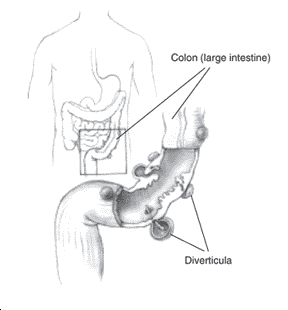 Diverticulitis