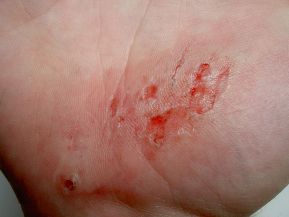 abrasion-on-hand