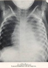 acute-bronchitis.jpg
