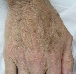 age-spots