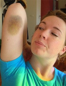 bruise2.jpg