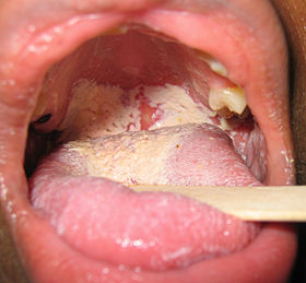 oral-thrush-candida