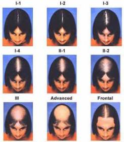 Baldness