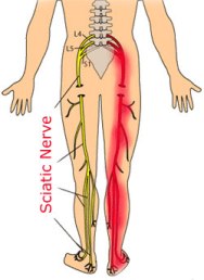 sciatic