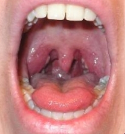 tonsillitis.jpg