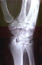 warren-wrist2-picture