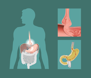 hiatus-hernia