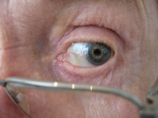 eye mature